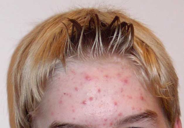 acne breakout on the forehead
