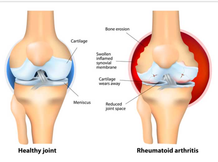 diagram of a joint with arthritis