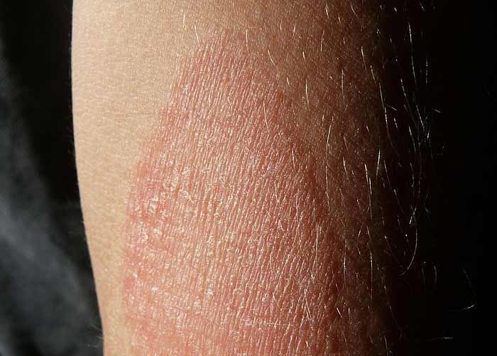 Skin with a patch of eczema