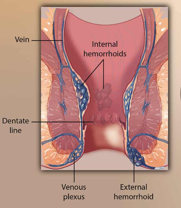 diagram of hemorrhoids