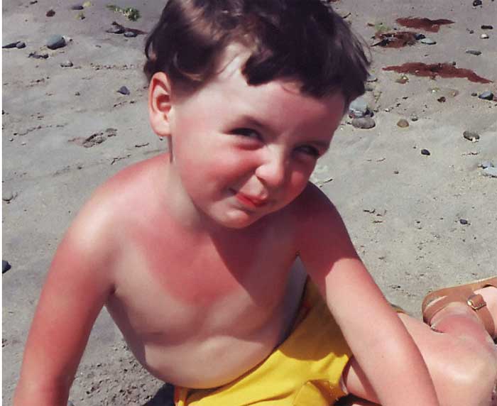 little boy with sunburn