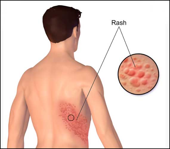 Illustration of shingles rash on back