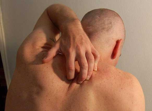 Man scratching itchy skin on his back