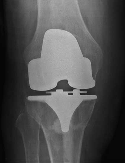 Xray showing knee replacement
