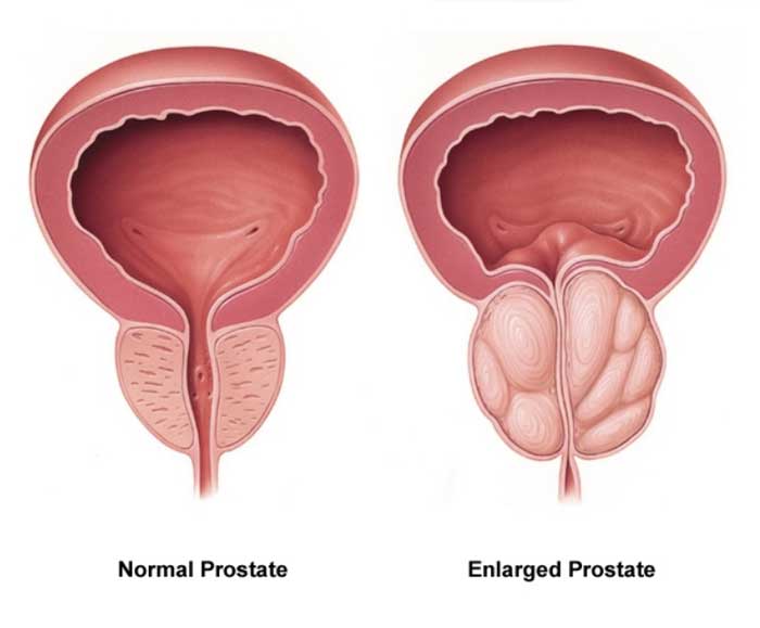 Normal and enlarged prostate diagram